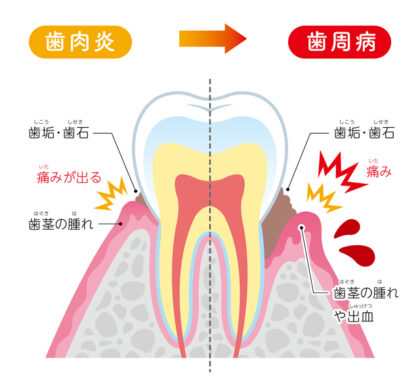 歯肉炎・歯周病【仙台】広瀬通り歯科クリニック