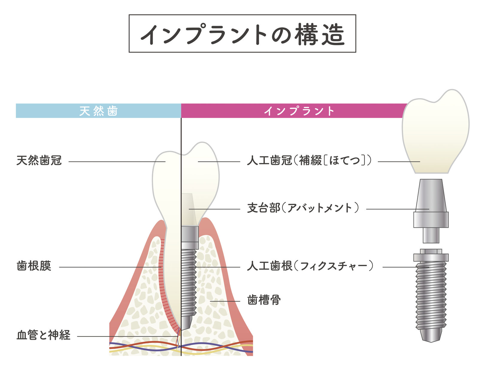 インプラント治療 | 仙台市青葉区の歯医者「広瀬通り歯科クリニック」です|広瀬通駅すぐ