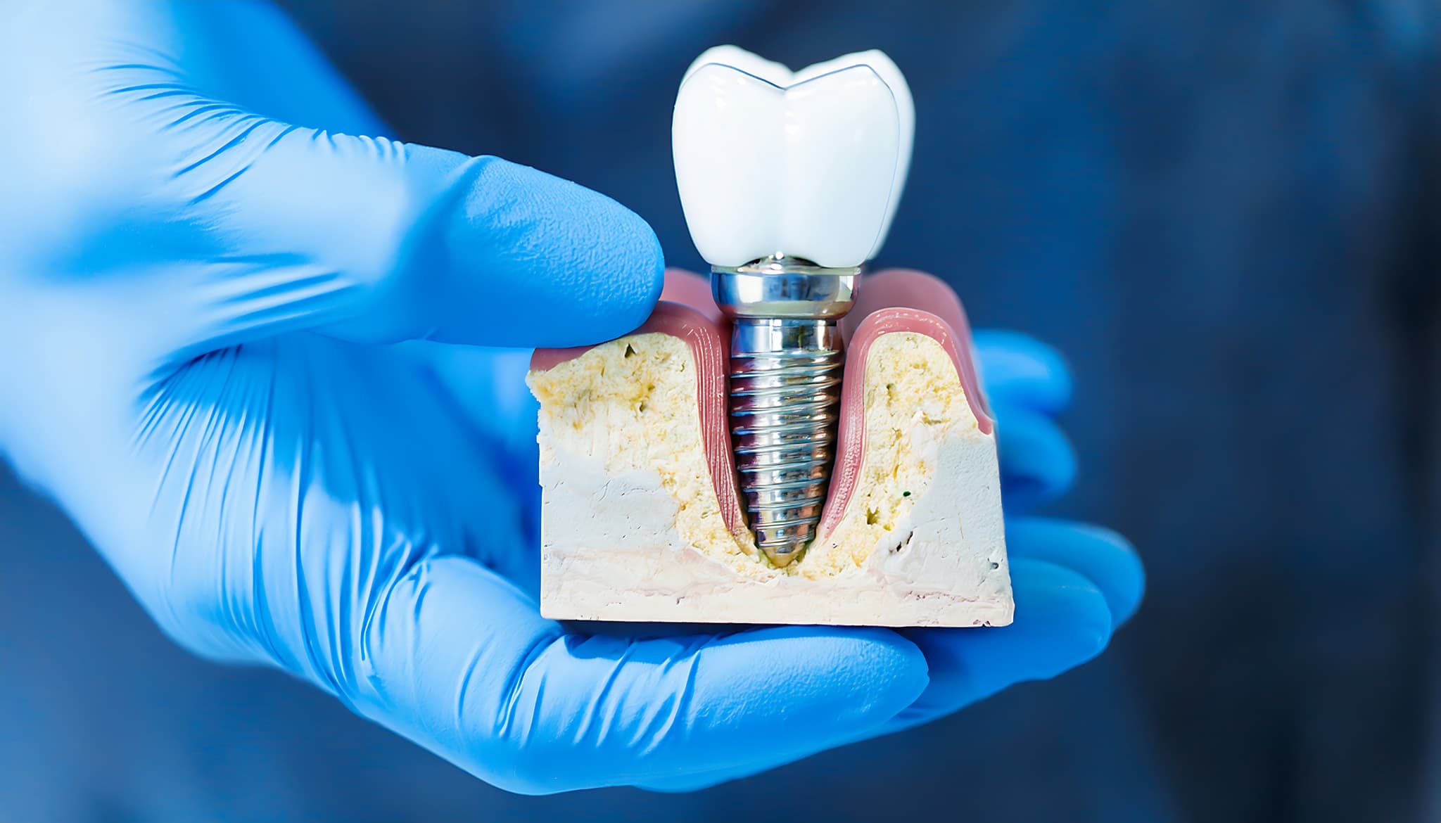 インプラントとはどのようなものか説明する歯科医師