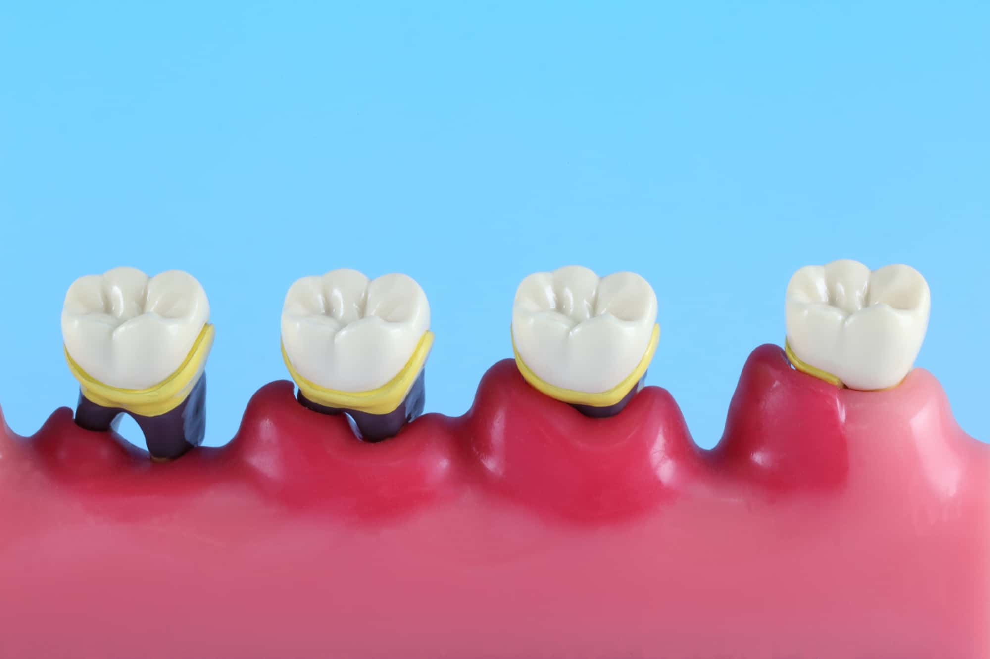 歯肉炎から歯周炎を経て歯周病に進行していくイメージ