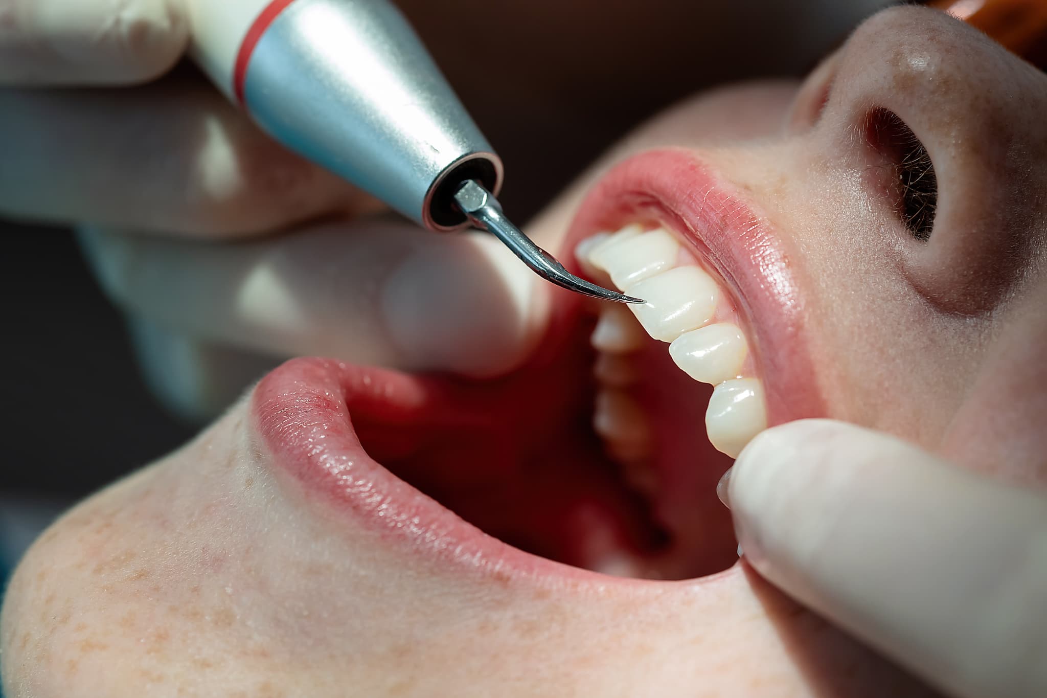 スケーリングの様子